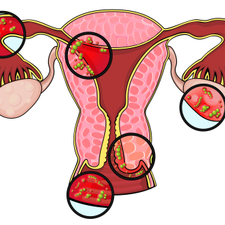 多囊卵巢检查方法全解析：B超激素六项诊断标准