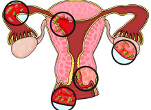 促排卵治疗是否导致卵巢早衰？科学解析长方案的安全性