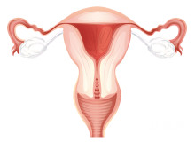 多囊卵巢综合症怎么治疗最有效？2025年权威医生分享治疗全方案