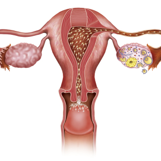 多囊卵巢试管多少钱？2025年最新费用明细公开