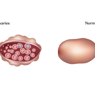 多囊卵巢检查需要多少钱？2025年最新费用解析及省钱指南