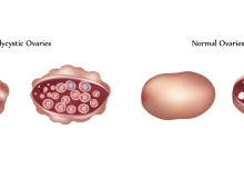 巧囊做试管与自然受孕对比，成功率差异及选择策略分析
