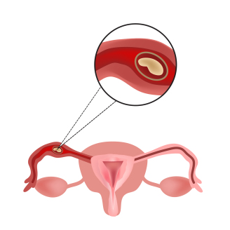 多囊卵巢怀孕早期注意事项全解析:孕妈必知的健康管理要点