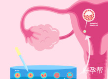 多囊卵巢腹腔镜手术：适应症、操作流程及术后恢复指南